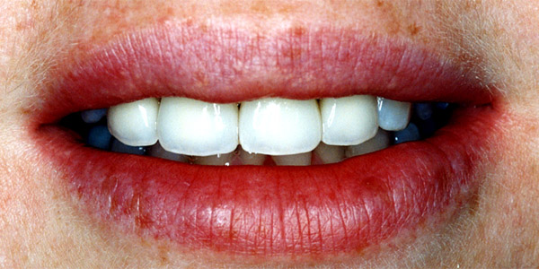 Cosmetic Dental Treatments