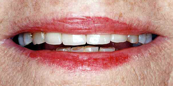 Cosmetic Dental Treatments