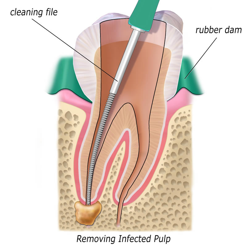 Root Canal