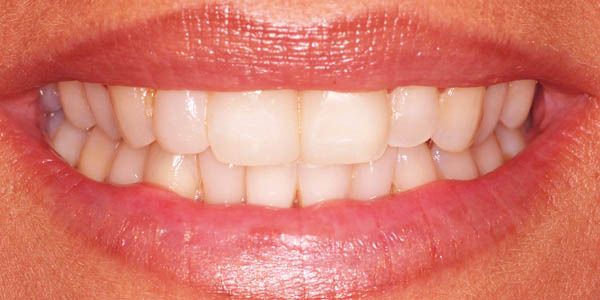 Cosmetic Dental Treatments