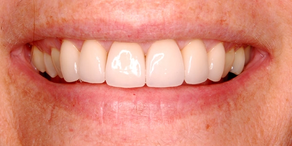 Cosmetic Dental Treatments