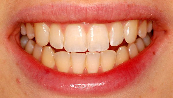 Cosmetic Dental Treatments